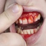Bleeding Gums Treatment