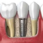 Dental Implant Fixing