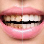 Dental Laminates