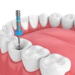 Endosurgery
