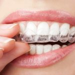 Invisible And Clear Braces