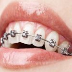 Metal Braces Fixing
