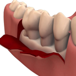 Periodontal Flap Surgery