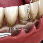 Scraping Periodontal