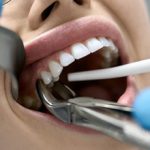 Surgical Tooth Extraction
