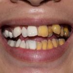 Teeth Scaling and Polishing