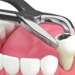 Tooth Extraction