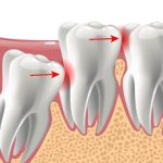 Wisdom Tooth Extraction